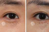 [나노 눈성형] 뒷트임-아랫눈매내리기,아랫눈매교정술 전후비교