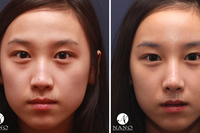[나노 코성형] 시술내용 - 메부리코성형 + (얼굴전체 지방이식) [내부 페이지 상세 측면, 정면 사진 有]