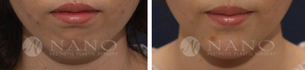 [나노 무턱성형] 턱보형물을 이용한 무턱성형 ★세부사진첨부★
