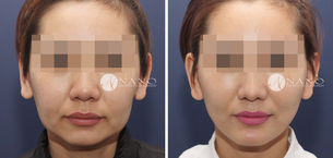 [나노 안면거상술] 입가,볼, 턱선처짐 개선
