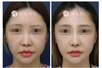 [나노 코성형] 코 재수술 휜코, 코끝 성형