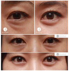 [나노 눈성형] 시술내용 - 눈밑 지방제거 ★세부사진 첨부★