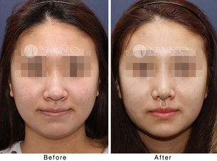 [나노 코성형] 복코, 낮은코성형
