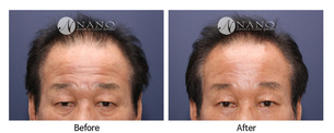 [나노 내시경이마거상술] 중년남성의 이마주름개선