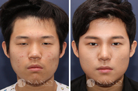 [나노 내시경이마거상술] 남성 이마거상술 과 코성형 환한 이미지 변화