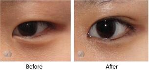 [나노 눈성형] 시술내용 - 나노 눈성형 부분절개 ★세부사진 첨부★