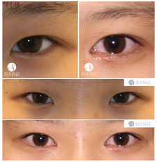 [나노 눈성형] 무흉 앞트임 ★세부사진 첨부★