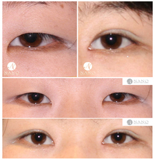 [나노 눈성형] 눈성형 ★세부사진 첨부★