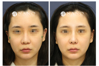 [나노 코성형] 낮은코+코끝+미간 개선 재수술 사례