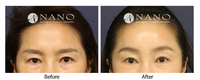 [나노 내시경이마거상술] 처진눈꺼풀과 인상 개선사례
