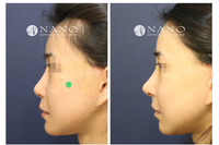 [나노 코성형] 코 재수술 코끝 개선 사례