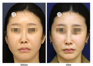 [나노 코성형] 비공 노출,비대칭 + 코끝 개선 재수술 사례