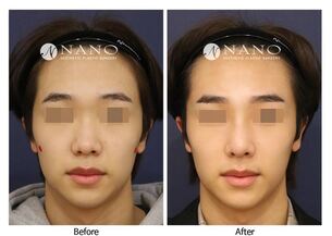 [나노 코성형] 낮은 미간과 콧대 남자코 개선사례