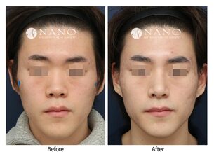 [나노 코성형] 미간이 낮고 코끝이 들려보이는 남자코 사례