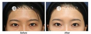 [나노 이마거상] 환한 인상 개선 사례