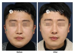 [나노 코성형] 맞춤형 보형물을 사용한  낮고 휜 코 재수술