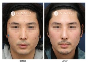 [나노 코성형] 콧대 라인이 매끄럽지 못하고 코끝이 뾰족한 남자코 재수술 사례